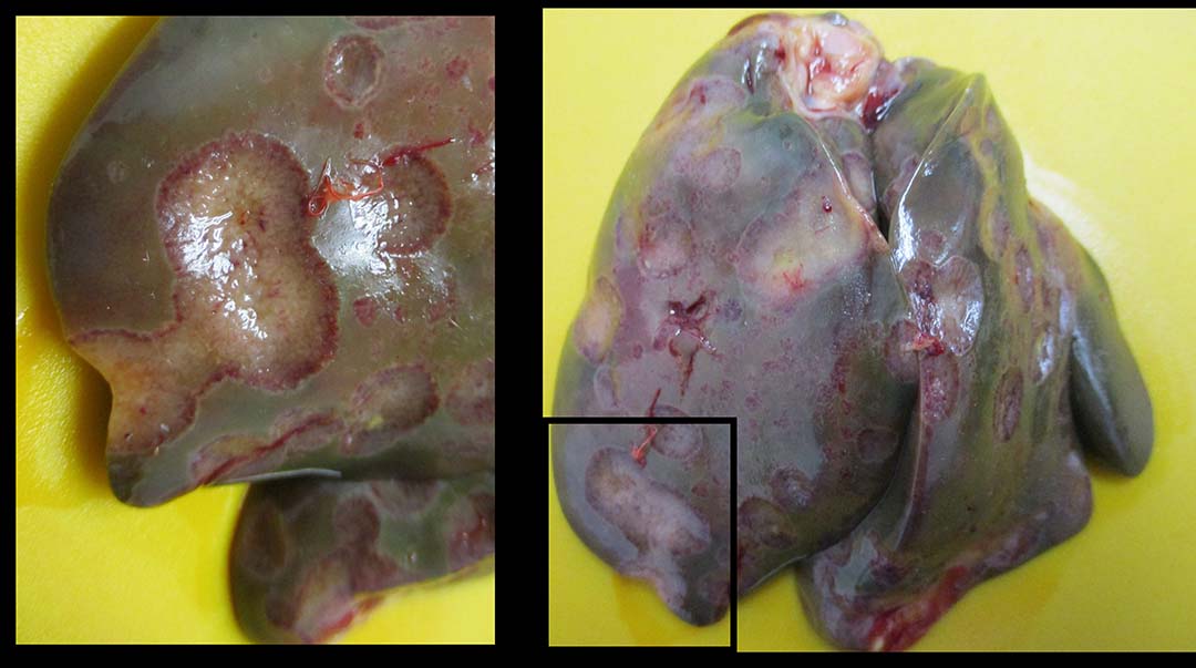 Figure 5 - Saucer-shaped lesions in the liver.